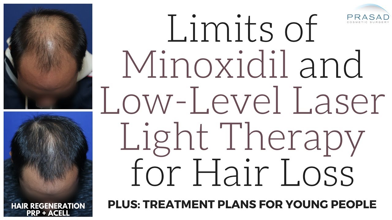 Limits of Low-Level Laser Therapy and Minoxidil for Hair Loss, and a  Treatment Plan for Young People - YouTube