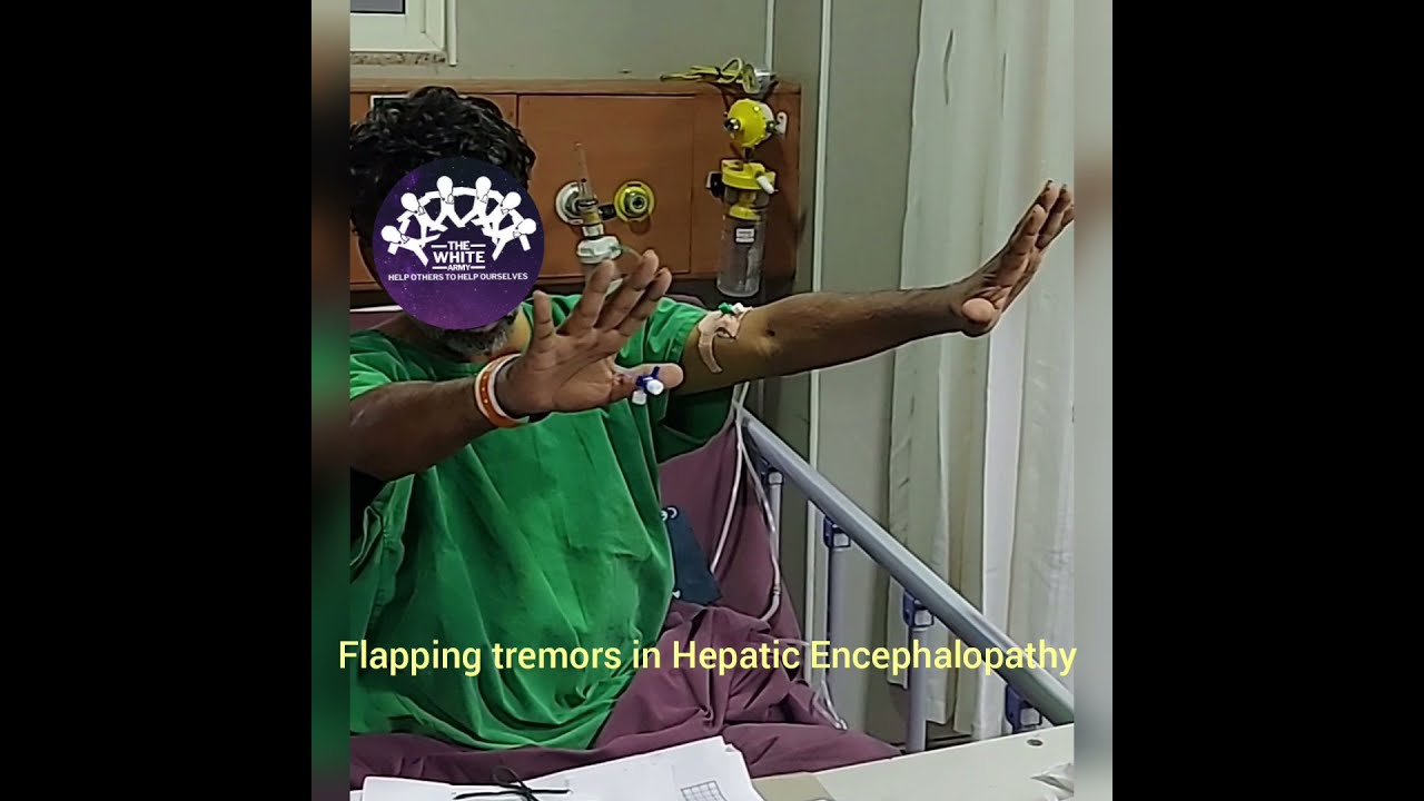 FLAPPING TREMORS IN HEPATIC ENCEPHALOPATHY YouTube