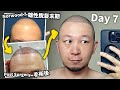 🔥終於做了！植髮手術！｜植飛日本全記錄【1】2500 grafts hair transplant, Norwood  7, Day 0 to 7