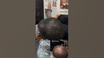 Phải làm sao khi tóc quá thưa và hói #xămtóc #reviewxămtóc #reviewxămtóc #scalp