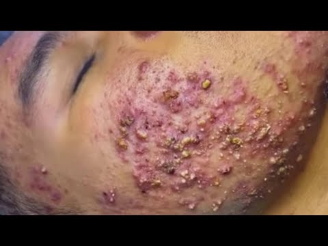  سيقوم الطلاء بتنظيف وجهك بشكل طبيعي