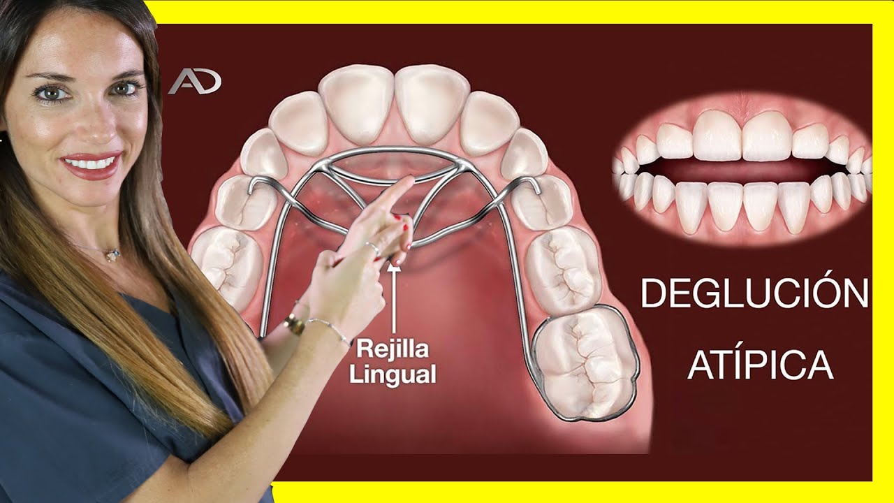 DEGLUCION ATIPICA ORTODONCIA CERRAR MORDIDA ABIERTA CON ORTODONCIA deglucion-atipica-ortodoncia-cerrar-mordida-abierta-con-ortodoncia