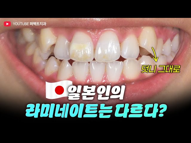 🇯🇵일본인이 많이 하는 당일 무삭제 라미네이트 케이스 3개🦷