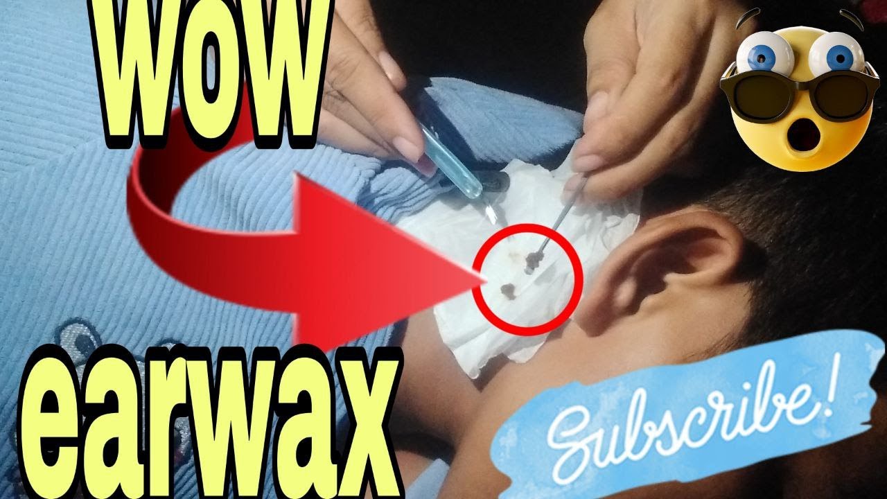HELP! SOMETHING'S STUCK IN MY EAR! NASTY EAR WAX REMOVAL AT NIGTH. #
