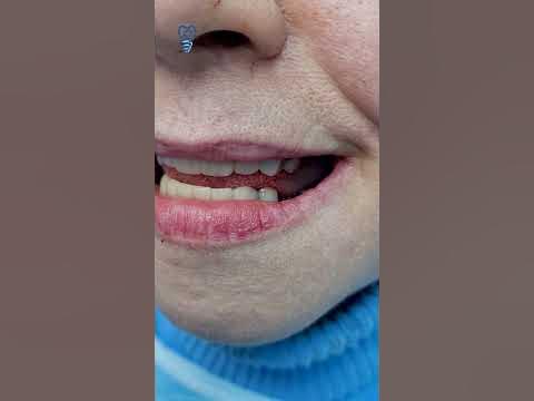 От прототипа до новых зубов за 2 часа. Имплантация зубов. - YouTube