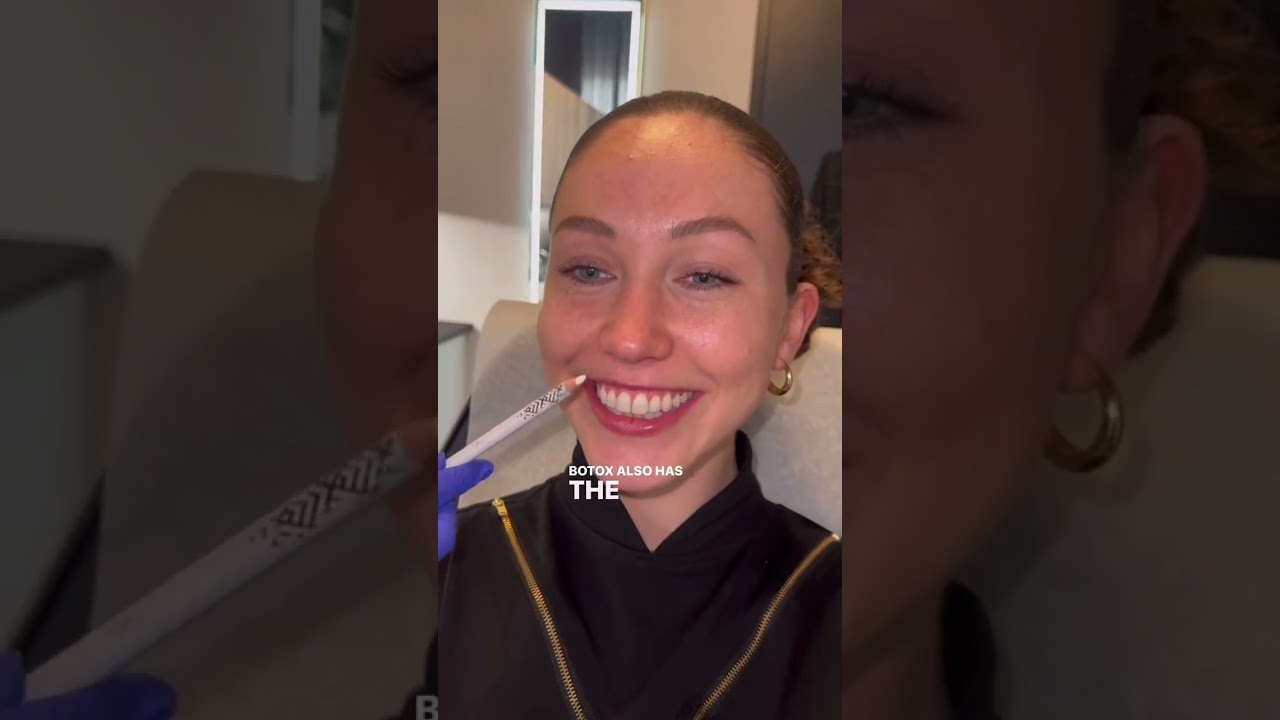 Gummy Smile - Botox for Gummy Smile - Book at Skin Vitality Ajax Today (905) 619-2639!