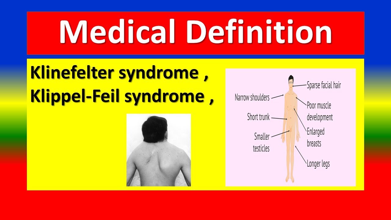 Klinefelter Syndrome Klippel Feil Syndrome Medical Definition Youtube