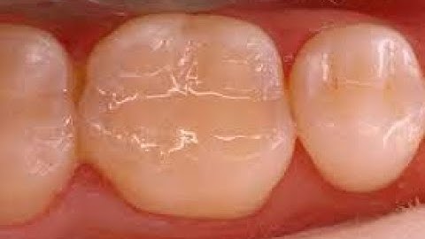 Problem - Your new Class 2 composite has a weak or open contact. Solution - Dr. Joel N. Janis