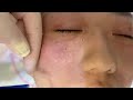 How to use a 4-pin Multi Injector Needle https://billsu.com/product/needle-mask/#mesotherapy