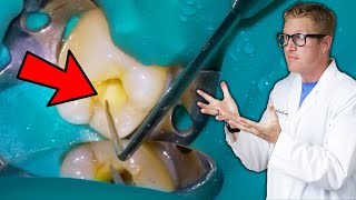 Pain After Root Canal! Dentist Explains Every Cause of Endodontic Soreness & Why Things Hurt