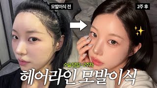 I finally did it..🧑🏻‍🦲🎀 A genuine review of a hairline transplant paid for with my own money💸 (Fr...