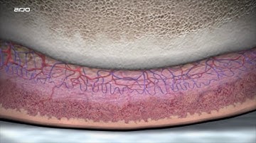 Microclimate Management | Pressure Injury Prevention | Arjo Global