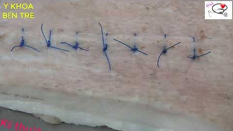 Kỹ thuật cắt chỉ vết thương mũi khâu Donati