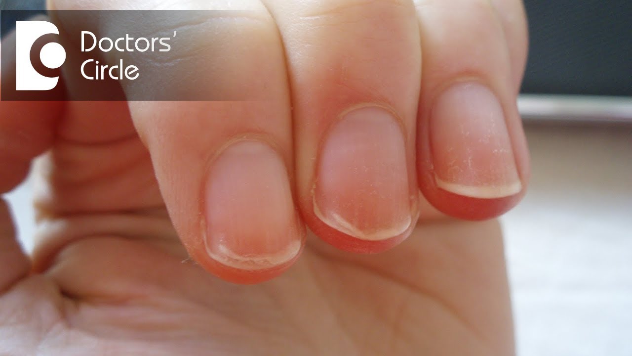 Red Lines On Fingernails - Causes, Prevention & Treatment