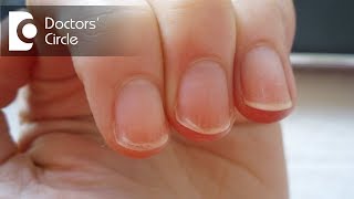 What can cause peeling of nails in an individual? - Dr. Aruna Prasad