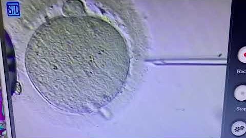 ICSI Procedure