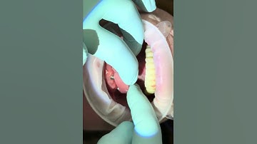 Installing a verification jig . Make sure your implants are correct in your model!!