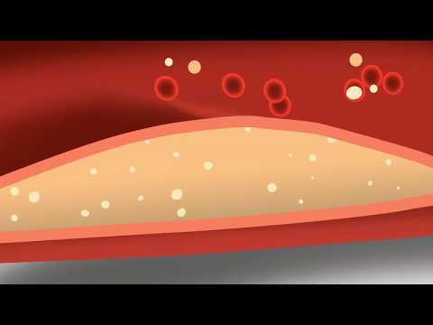 Видео: Артерийн холестеролыг бууруулах 3 арга