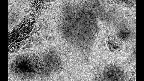 Beating cardiomyocytes derived from HDF iPSCs