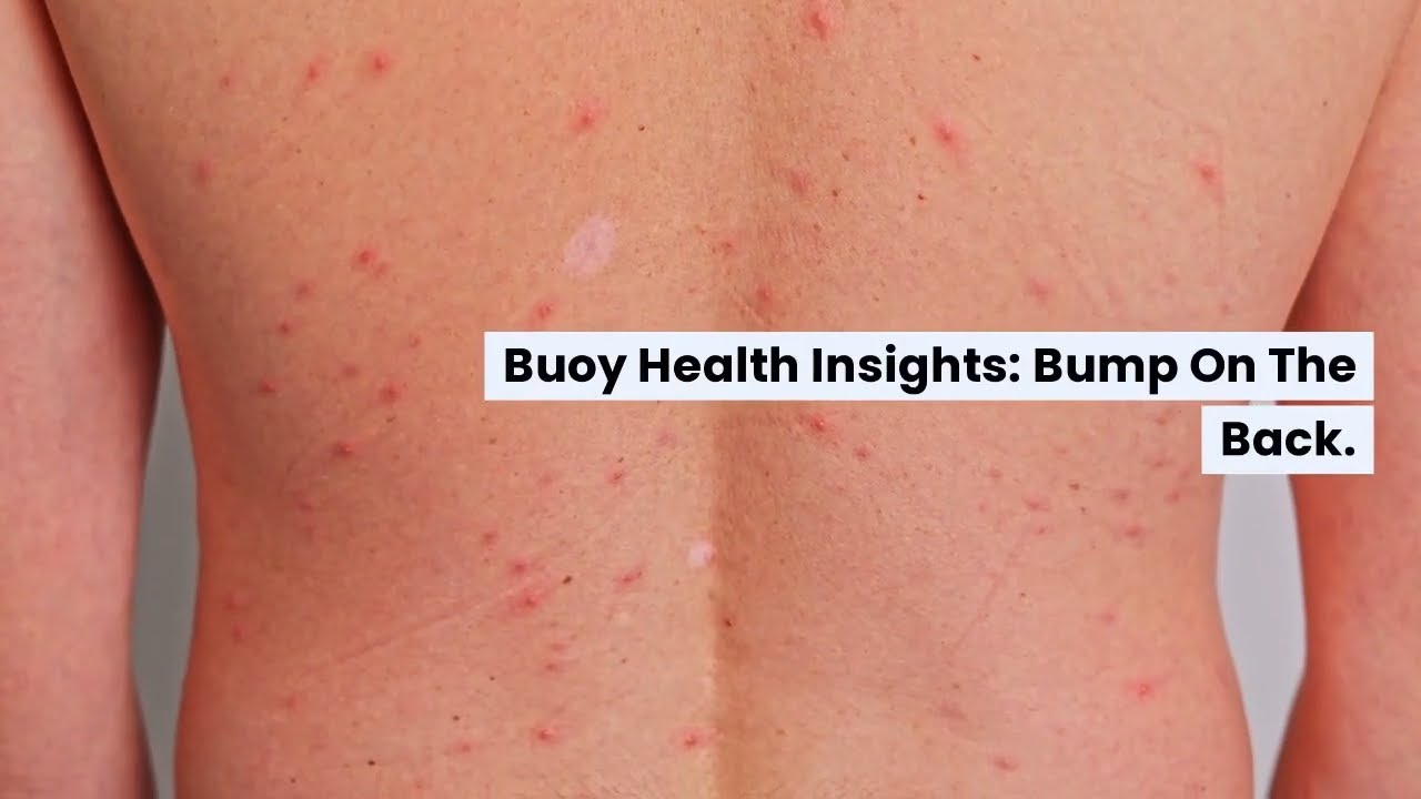 Bump On The Back Common Causes And When To Seek Medical Care Maxresdefault