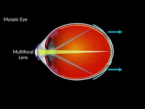 Video: Spomalia kontaktné šošovky krátkozrakosť?