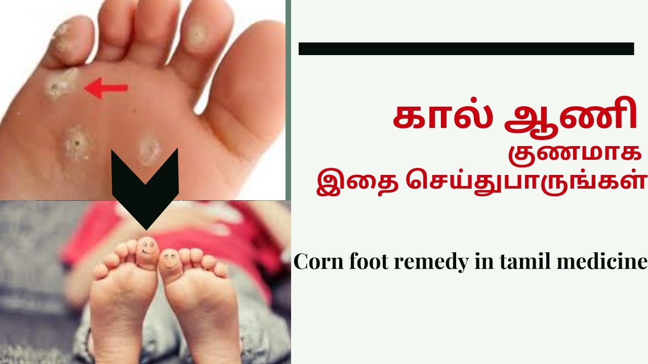 கால் ஆணி குணமாக இதை செய்து பாருங்கள்/Corn foot remedy in tamil medicine