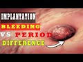 Implantation Bleeding Vs Period – (How to Know the Difference?) 🩸🩸