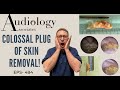 COLOSSAL 3CM/1.25 INCH EAR CANAL SKIN PLUG REMOVED - EP484