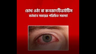 চোখ ওঠা বা কনজাংটিভাইটিস II কারন,লক্ষন এবং করনীয় কি ?