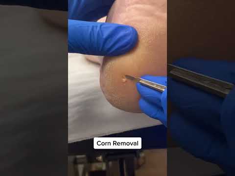 Satisfying painful hard corn removal by australian podiatrist