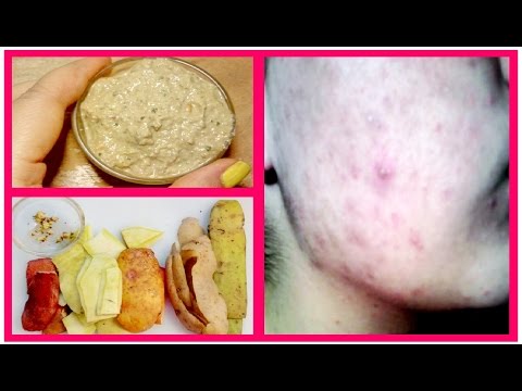 ज़ख़्मी मुहांसे, उसके दाग का अचूक इलाज़,Remove PIMPLES,Acne & SCARS, मुंहासों के घरेलू उपाय, Dr Shalini