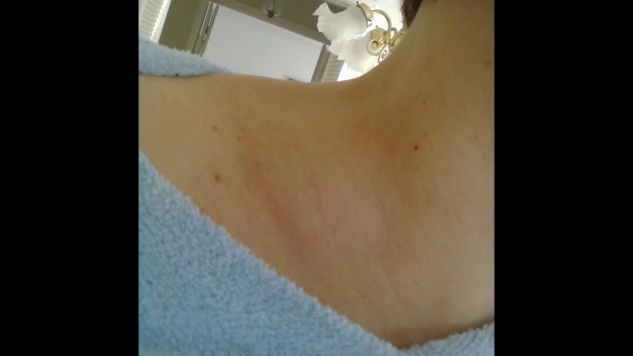 Swollen Lymph Nodes glands~Thyroid - YouTube