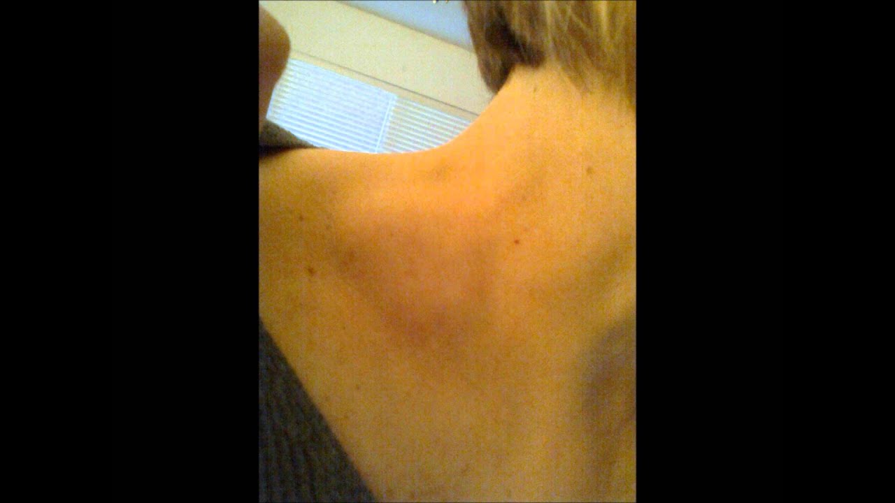 movable lump in neck movable lump in neck