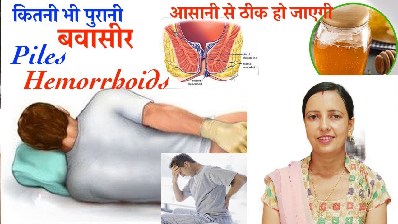 बवासीर की दवा Hemorrhoids How To Get Rid Of Piles