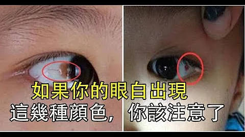 如果你的「眼白」出現這幾種顏色，你該注意了！有可能患上這種病了，太重要了，也幫家人看一下吧！ - 天天要聞