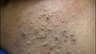 ASMR Blackheads and Pimple Removal | Daily Facial Care Routine