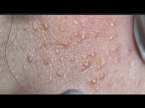 Hidden white bumps, like rice grains. - YouTube