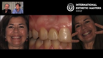 From Bone To Ceramics - New Perspectives on Socket Shield