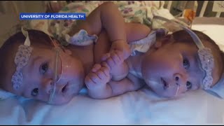 Doctors Separate Conjoined Twins With Help of 3-D Printing