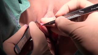 高須クリニック　 小陰唇縮小クリトリス包茎手術　 手術映像① 余分な組織をメスで切除し、バイポーラーで出血を止めるまで　 綺麗に整った女性器にします