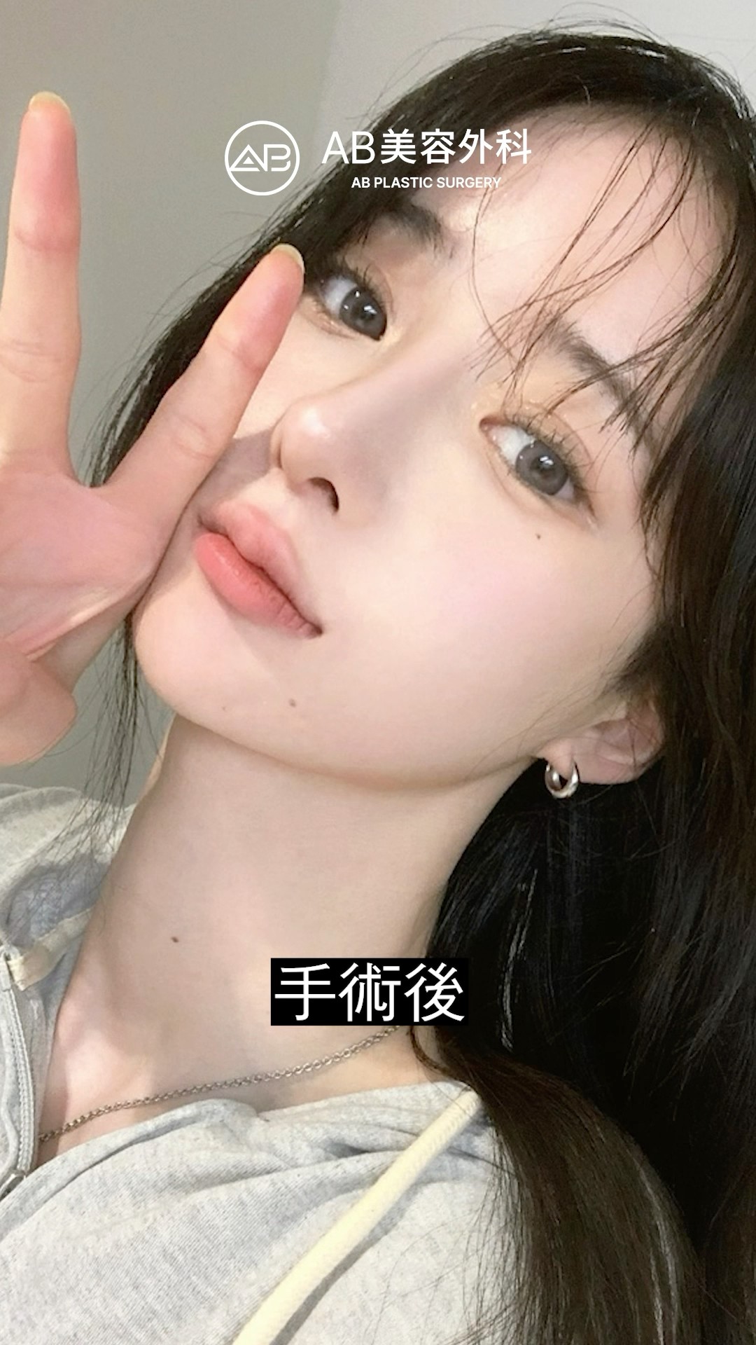 目鼻輪郭整形の3点セット! 変化がすごすぎる | AB美容整形