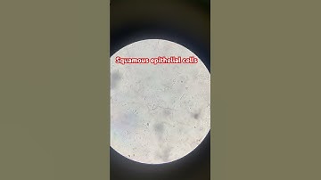 Squamous epithelial cells in urine #Pathology #urine microscopy (40xview)