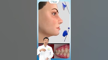 Niềng Răng Hàm Hẹp, Khớp Cắn Ngược | Bác Sĩ Yên