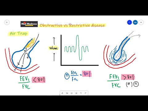 FEV1/FVC ratio in Obstructive vs Restrictive diseases | RS physiology | Med Madness