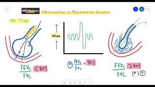 FEV1/FVC ratio in Obstructive vs Restrictive diseases | RS physiology | Med Madness