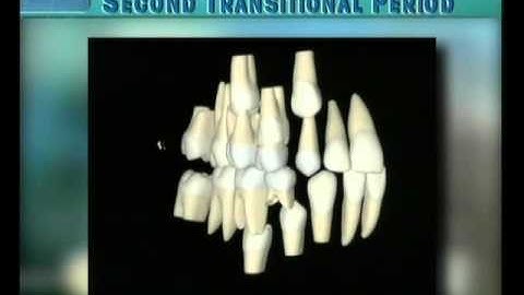 Clip 16: Transition of Canines and Premolars with Excess of Space