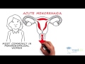 Obstetrics and Gynecology – Abnormal Vaginal Bleeding: By Kate Pulman M.D.