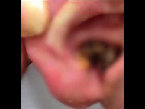 Video: 6 modi per curare le infezioni dell'orecchio