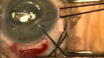 DSEK push in insertion w 30g needle