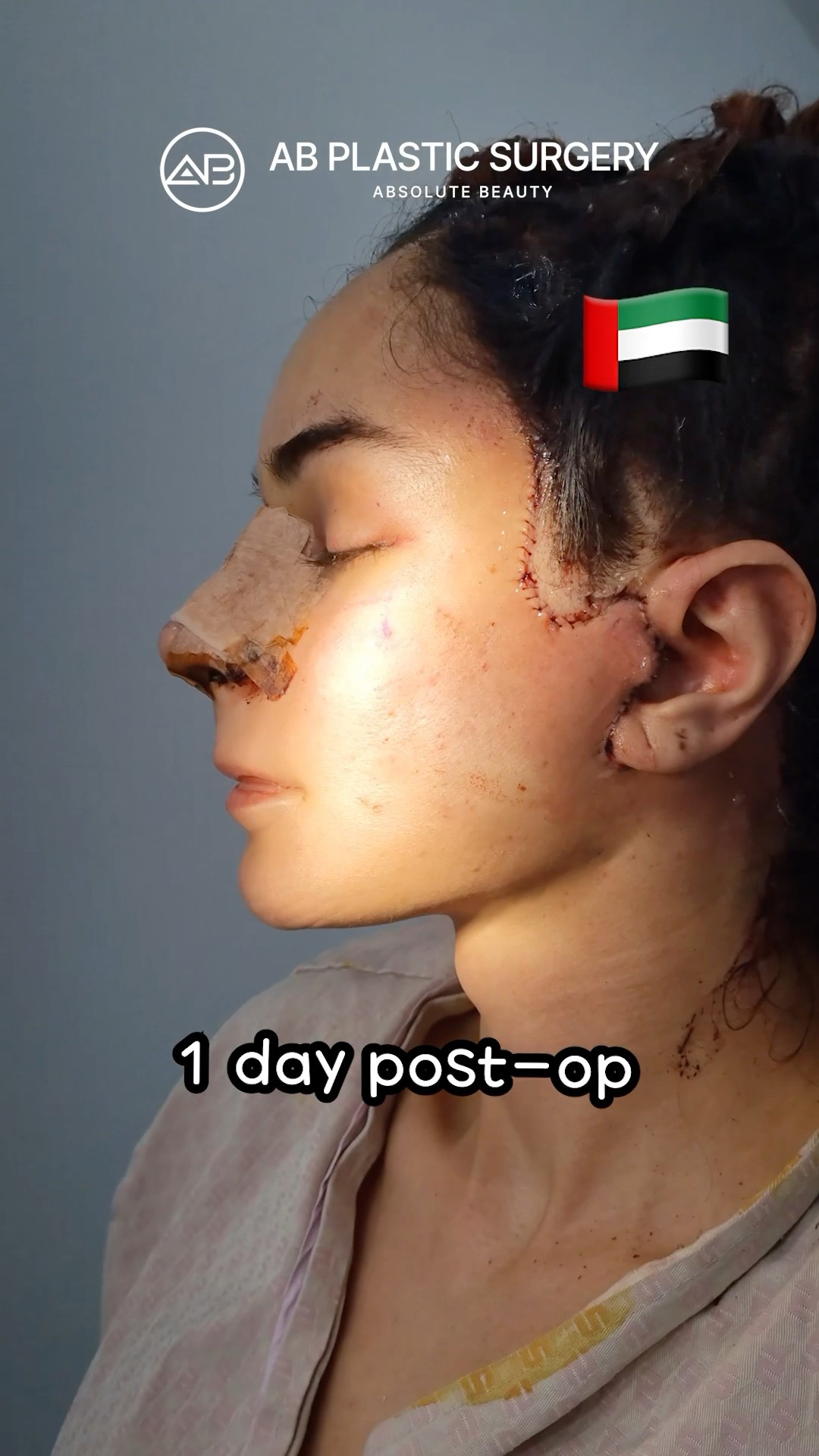 Dubai Woman’s Surgery Journey in Korea #koreanplasticsurgery